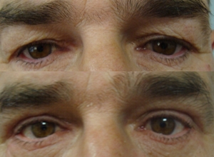 Upper blepharoplasty, after 2 months